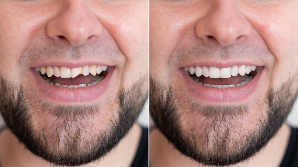 chipped teeth repair in kingsway