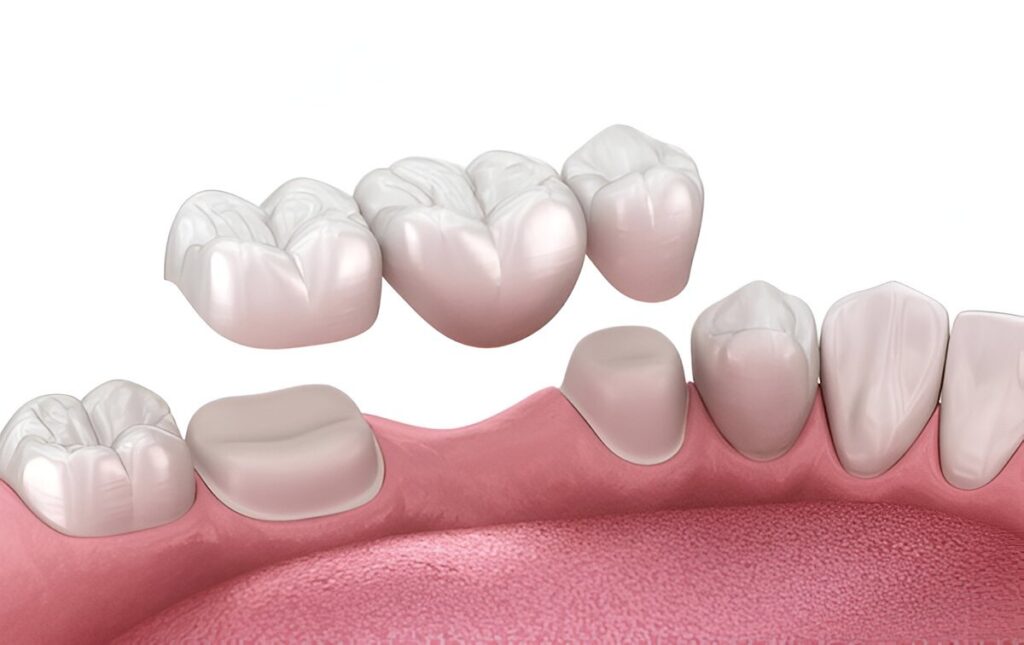 dental bridges in kingsway