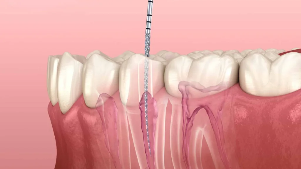 emergency root canal treatment in kingsway