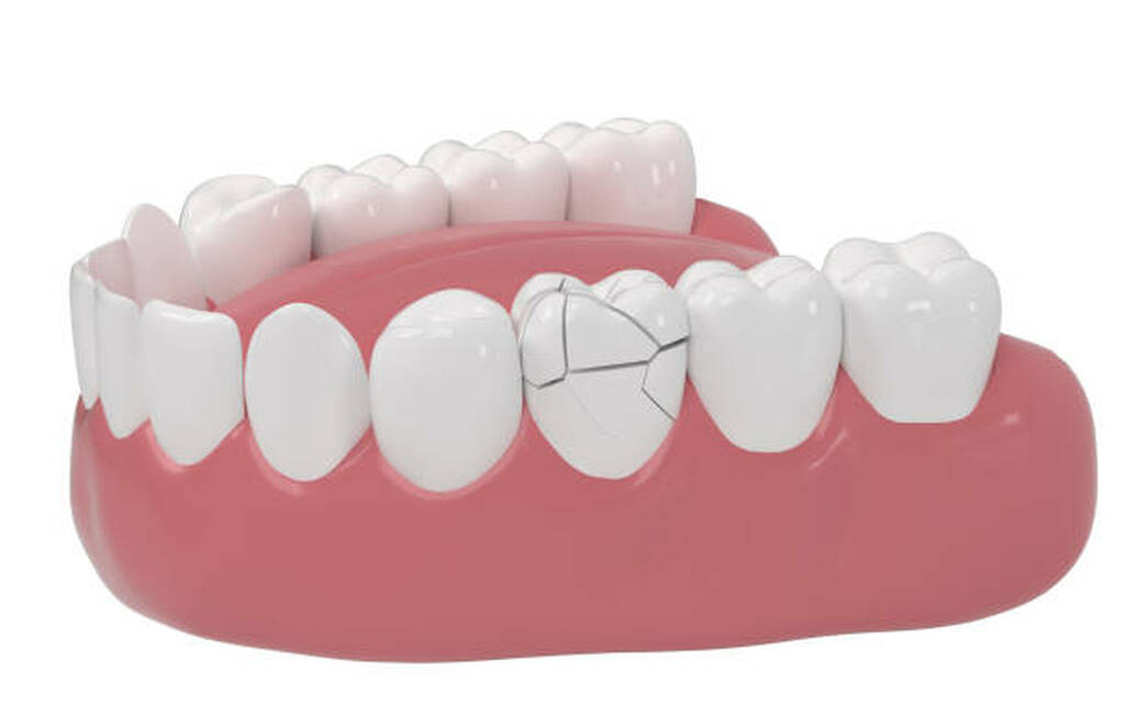fractured teeth repair in northland