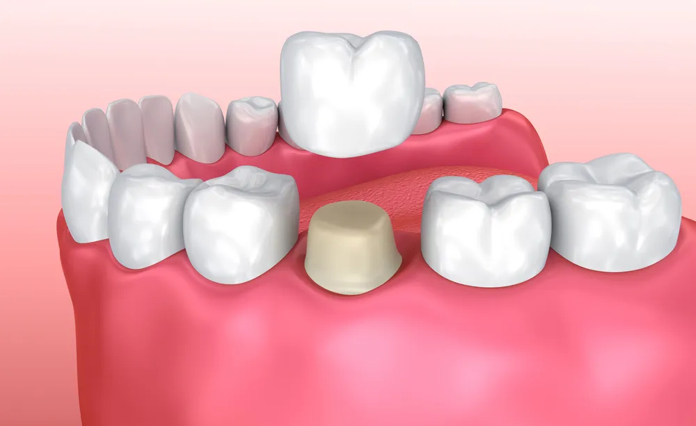 loose fillings and crowns in kingsway