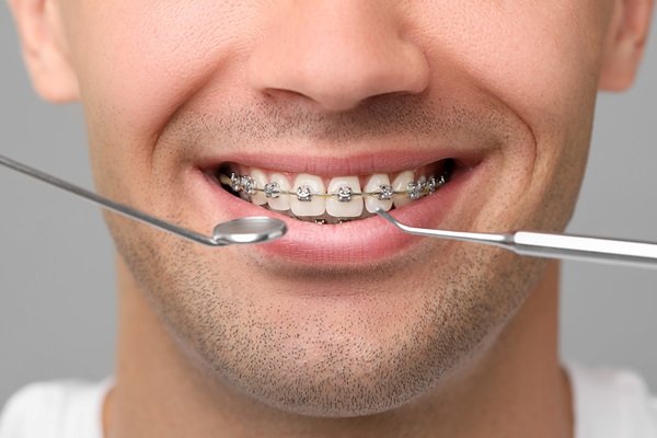 orthodontic maintenance in kingsway