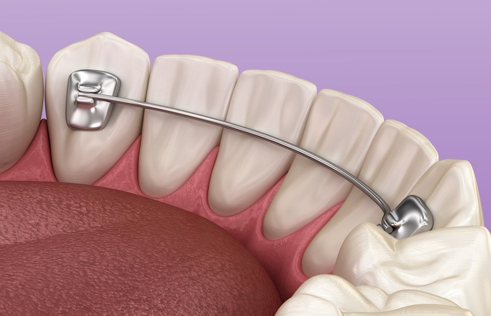 orthodontic retainers in kingsway