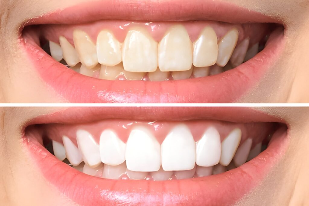 teeth whitening in kingsway