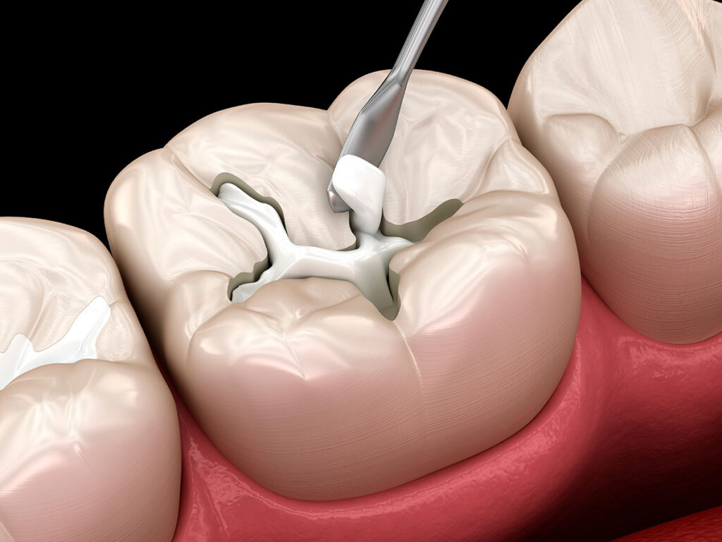 tooth coloured fillings near you