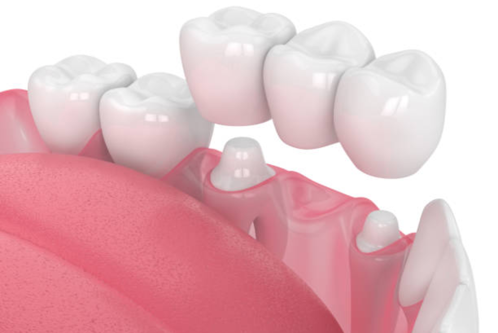 Do I Really Need a Dental Crown? Signs You Should Never Ignore