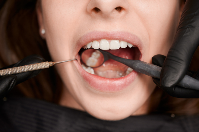 why choose inlays and onlays over crowns for dental restoration